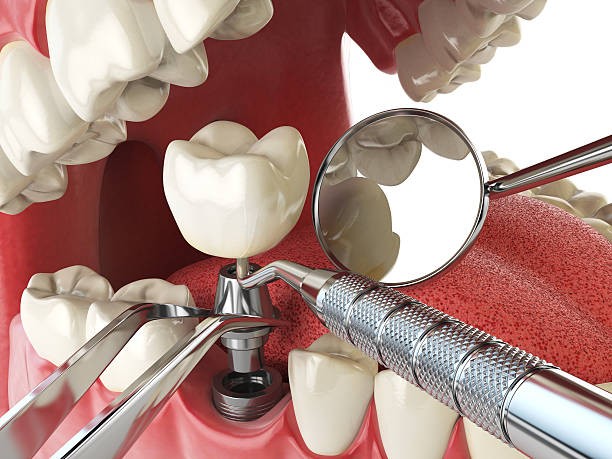 Best Knocked-Out Tooth Emergency  in Wetherington, OH